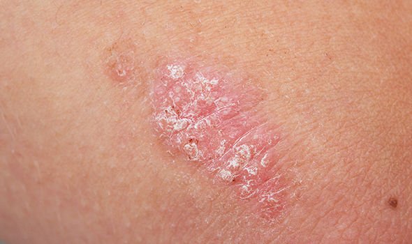 Skin-cancer-symptoms-Four-skin-conditions-that-raise-your-risk-of-developing-the-disease-1312525.jpg