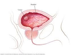 Bladder Cancer.jpg