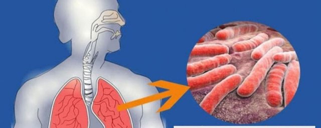 TUBERCULOSIS-1200x480.jpg