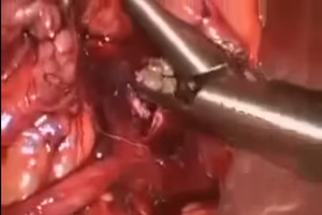 kidney_stone_removal_surgery.png