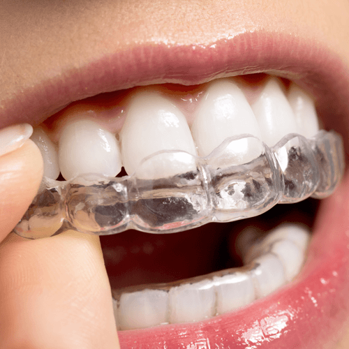 Pros and Cons of Invisalign_ What to Consider When Choosing the Right Brace.png