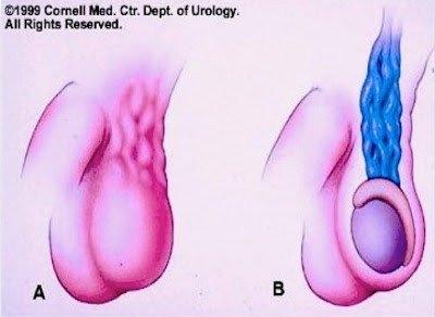 varicocele1.jpg