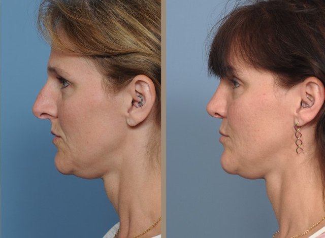 nose surgery austin tx.jpg