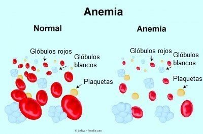 Anemia-por-deficiencia-de-hierro-1-400x265.jpg