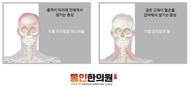 교통사고후유증 목통증 두통 통인한의원.jpg