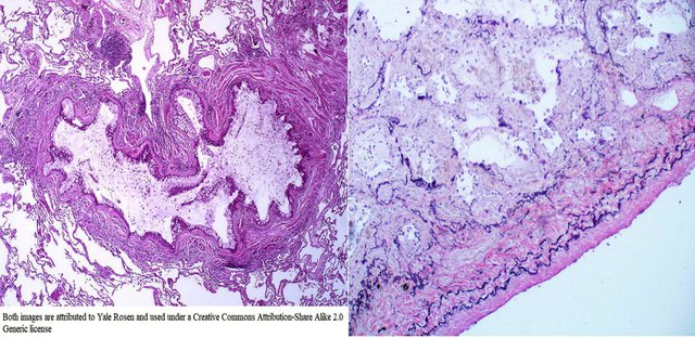 lung inflammation and healthy yale rosen 2.0.jpg