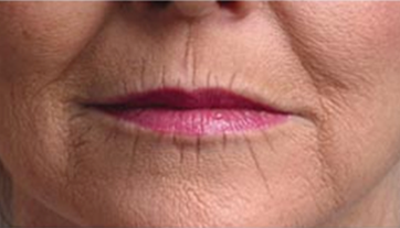 lip-line-treatment-charleston-sc.png