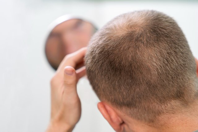 Remedy of alopecia areata (hair loss-baldness).jpg