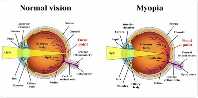 Myopia_short_sightedness_eye_vision_disorder_680x_-_Mrs_Bazilio.webp