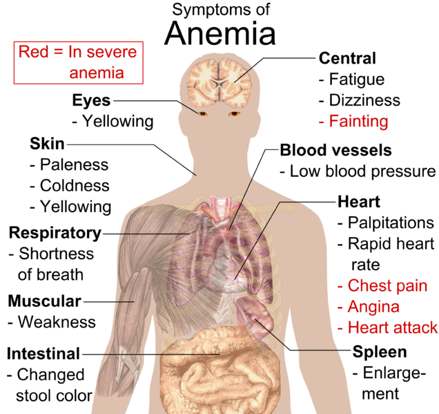 636px-Symptoms_of_anemia.png