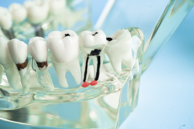 vecteezy_dental-implant-artificial-tooth-roots-into-jaw-root-canal_48726086.jpg