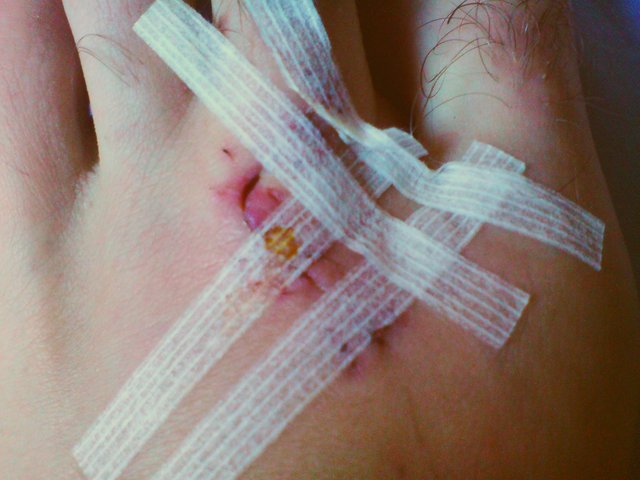 Wound Closure Strip new 1.jpg
