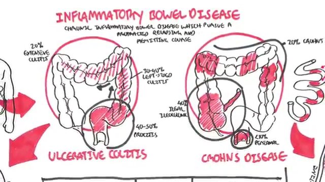 Inflammatory Bowel Disease.jpg