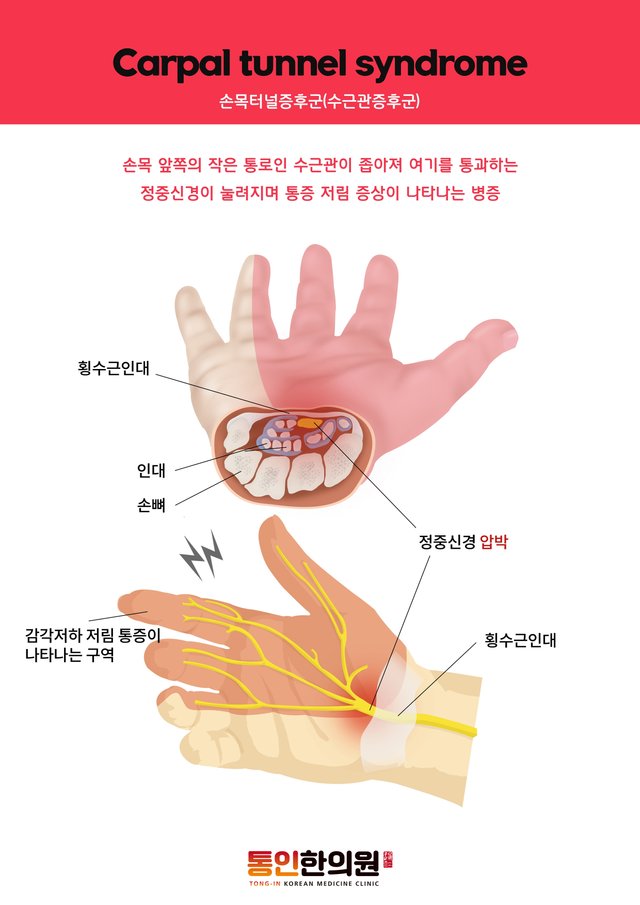 손목터널증후군.jpg