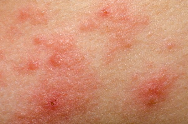 depositphotos_17972455-stock-photo-eczema-atopic-dermatitis-symptom-skin.jpg