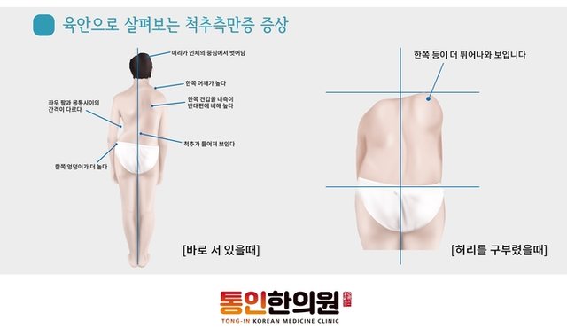 육안으로 살펴보는 척추측만증 통인한의원.jpg