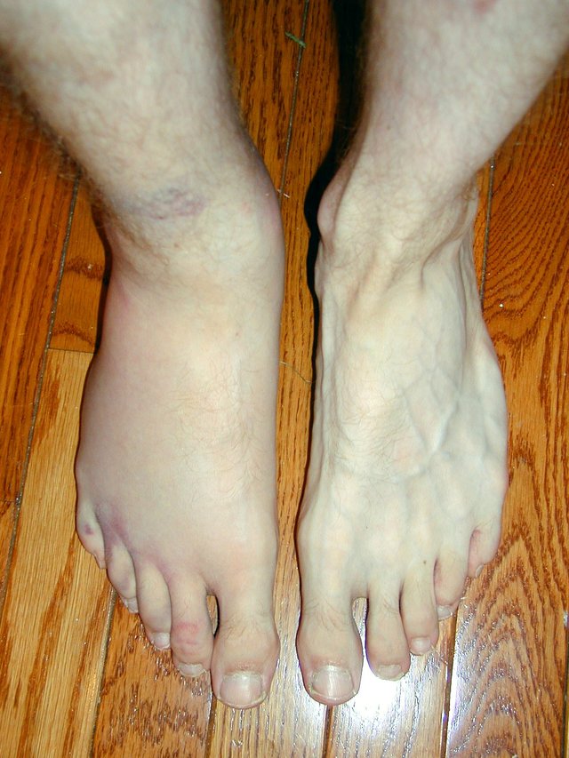 ankle2.jpg