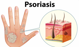 psoriasis.png