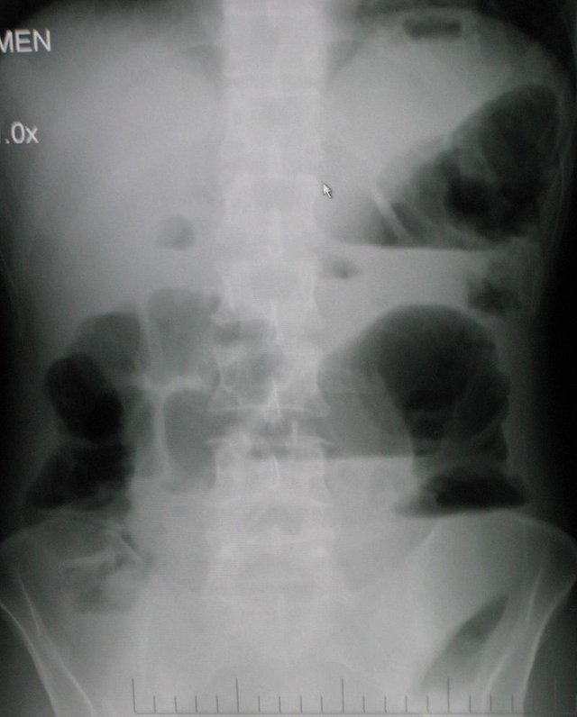 Upright_abdominal_X-ray_demonstrating_a_bowel_obstruction.jpg