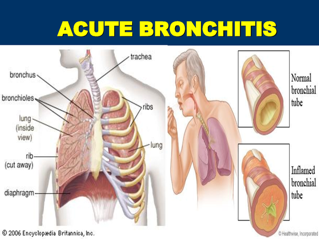 Acute Bronchitis In Adults And Children Causes, Symptoms, Diagnosis, Treatment, Prevention, Home Remedies.png