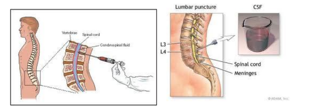 SPINAL PUNCTURE .png