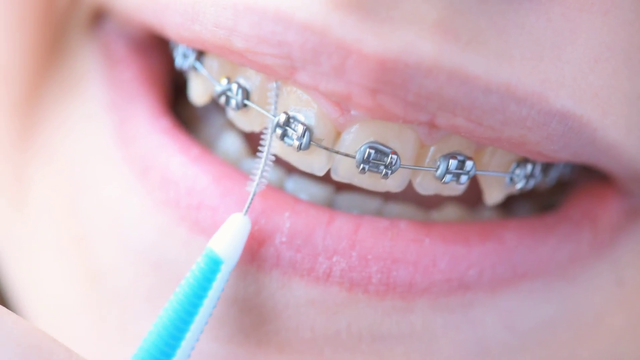girl-in-braces-cleans-her-teeth-with-interdental-brush-for-bracket-system_vt0w7pwhg__F0000.png