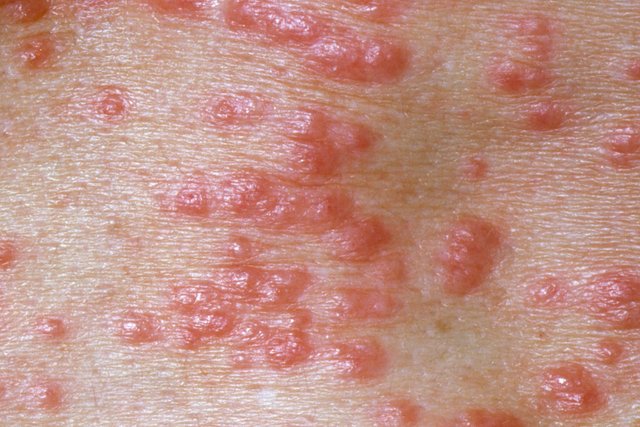 1800ss_princ_rm_photo_of_scabies_skin_infection.jpg