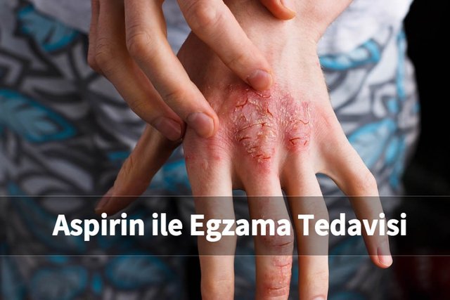 aspirin-ile-egzama-tedavisi-2.jpg