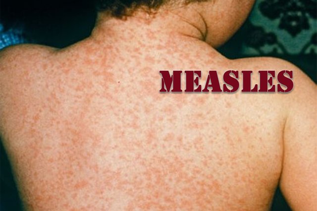 measles.jpg