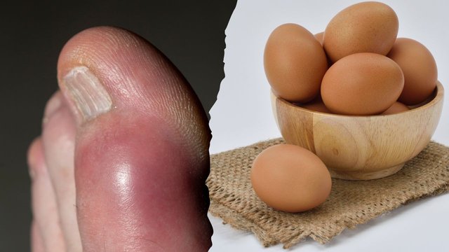 Are Eggs Bad for Gout.jpg