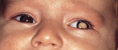 leukocoria_in_infant_with_retinoblastoma_high.jpg