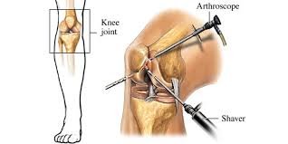 arthroscopic.jpg