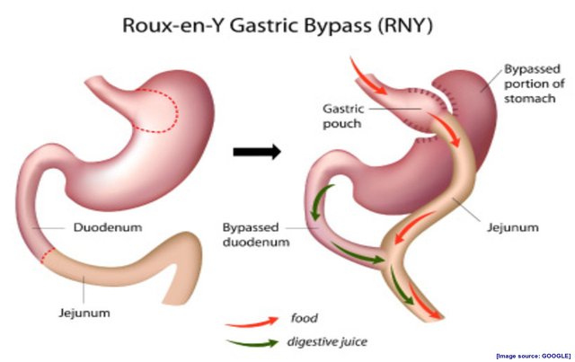 Gastric Bypass (Roux-en-Y).jpg