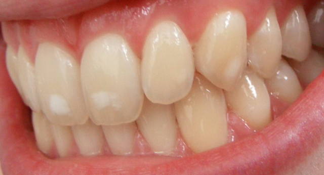 640px-Dental_fluorosis_(mild).png