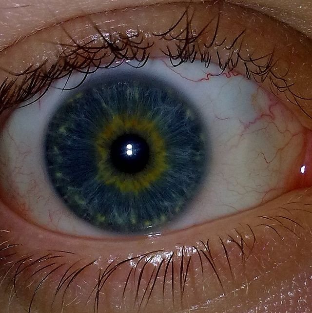 Central_Heterochromia,_Blue_&_Yellow_Eye.jpg