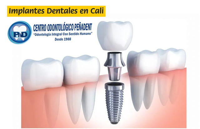 Implantes Dentales Cali.png