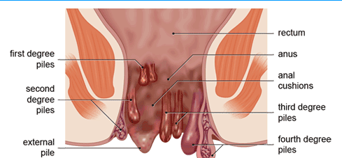 Piles-haemorrhoids-e1607064088971.png