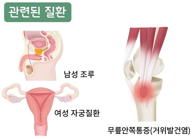 고관절내전근 관련된 질환 통인한의원.jpg