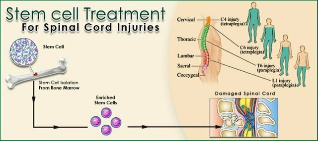 Stem Cell Treatment for Spinal Cord Injury .jpg