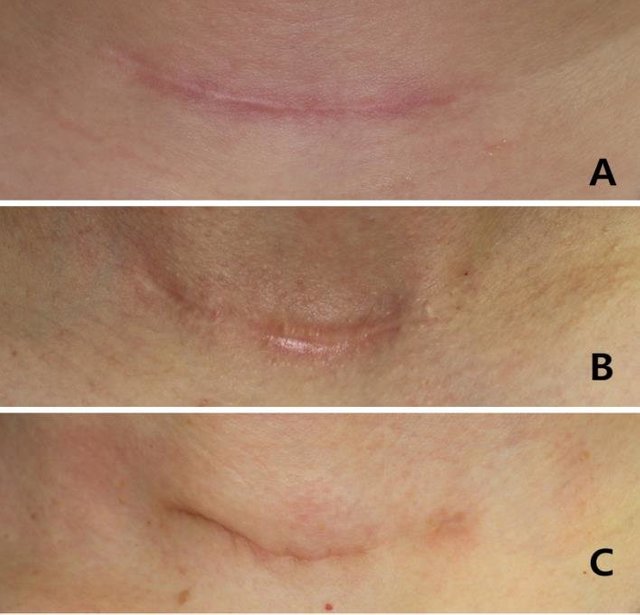 Three-types-of-scars-formed-after-transverse-cervical-incision-for-thyroidectomy-Typical.jpg