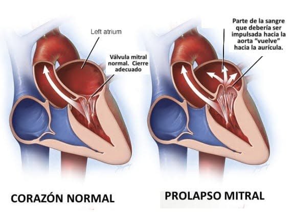 insuficiencia-mitral.jpg