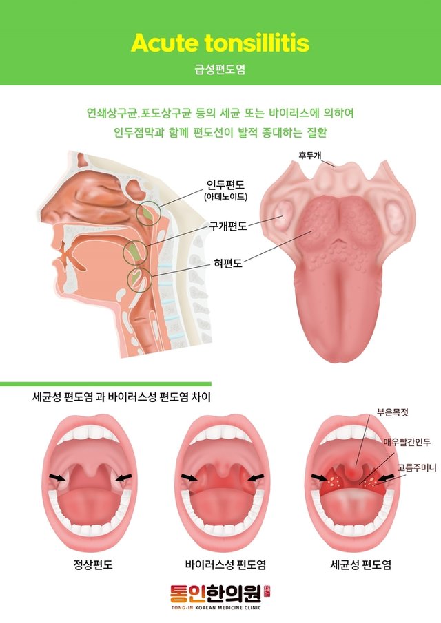 급성편도염 통인한의원 종로한의원.jpg