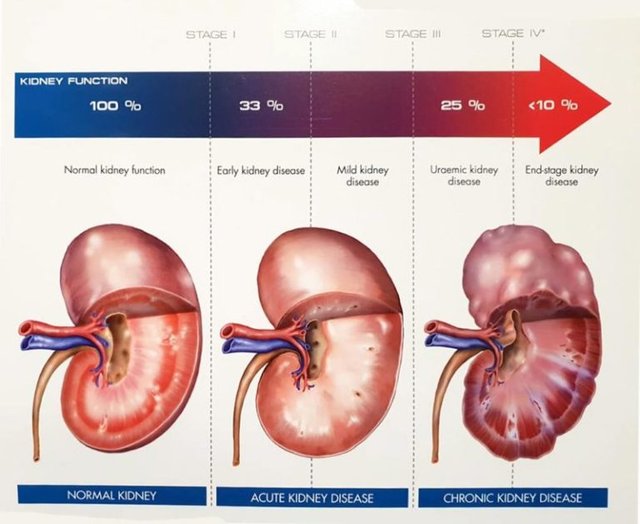 kidney-failure-800x656-1.jpg