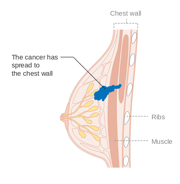 Diagram_1_of_2_showing_stage_3B_breast_cancer_CRUK_004.svg.png