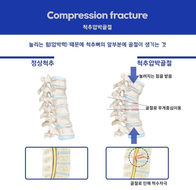 척추압박골절 통증부위 종로한의원.jpg