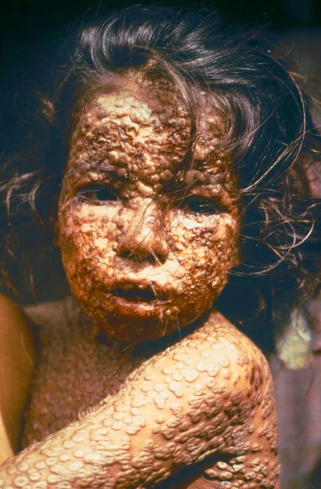 Child_with_Smallpox_Bangladesh.jpg