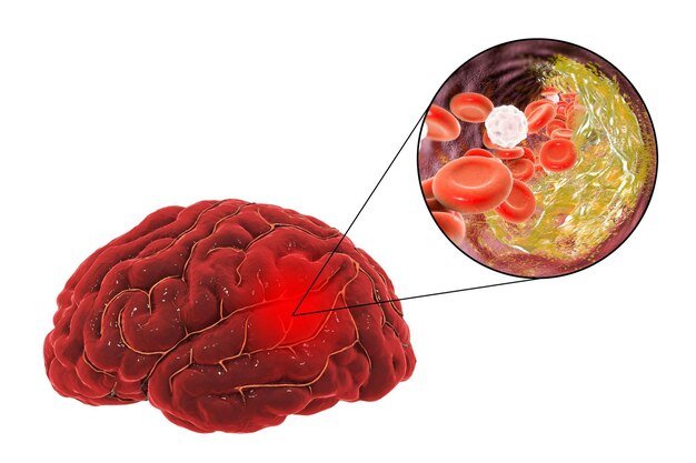 ischemic-brain-stroke-treatment-prevention-concept-3d-illustration-showing-human-brain-closeup-view-destruction-cholesterol-plaque-inside-brain-artery_938508-6095.jpg