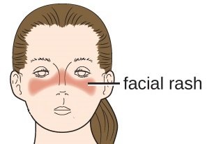 malar rash lupus diagram head.jpg