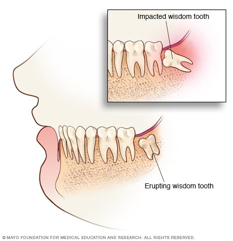 an01961_-ds00679_-my01212_im03691_de7_wisdomteeththu_jpg.jpg