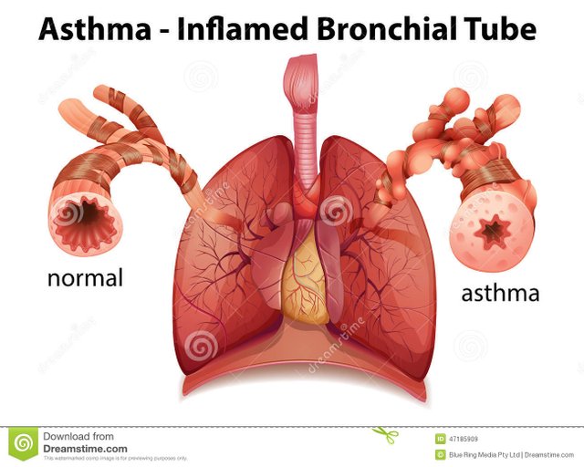 bronchial-asthma-image-showing-inflamed-tube-white-background-47185909.jpg